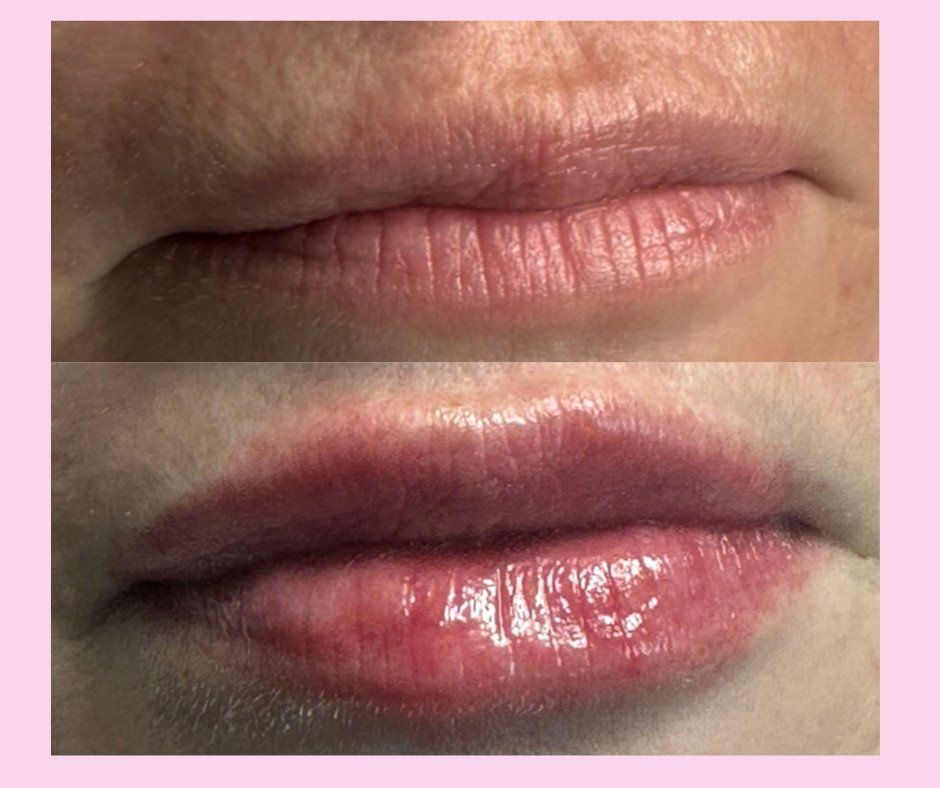Aumento de labios
