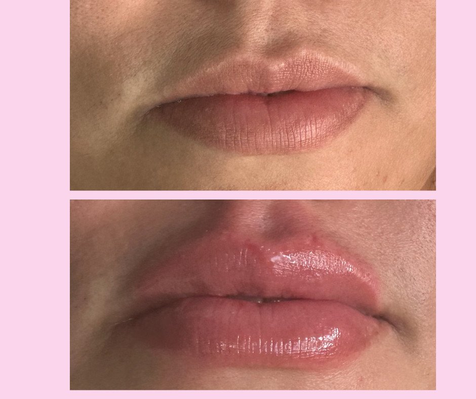 Aumento de labios