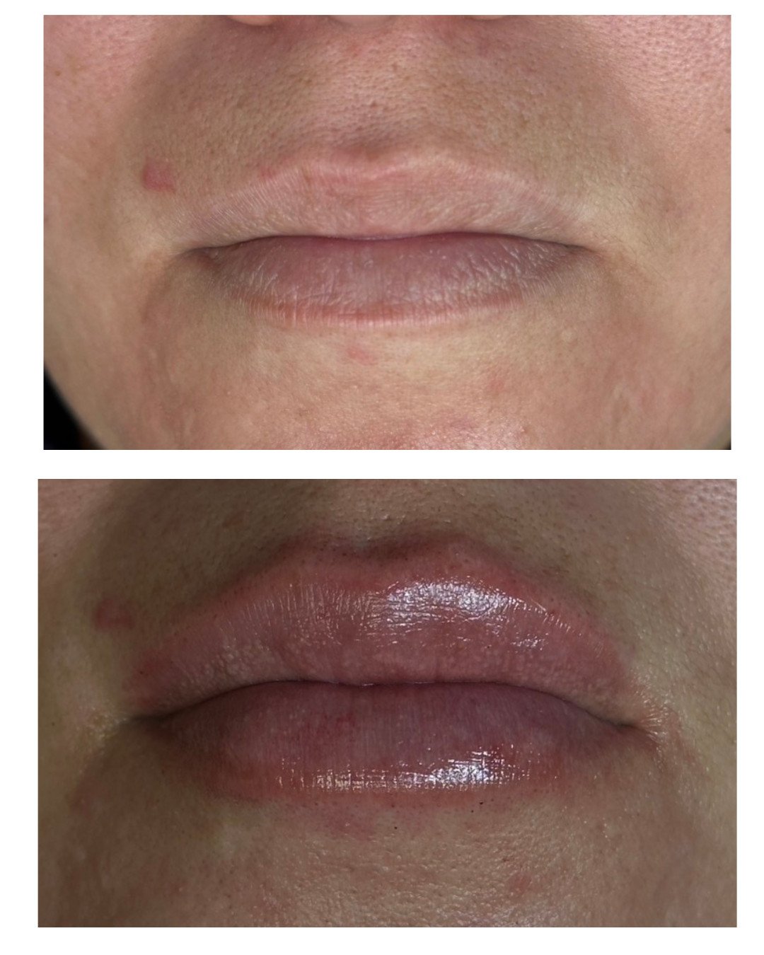 Aumento de labios