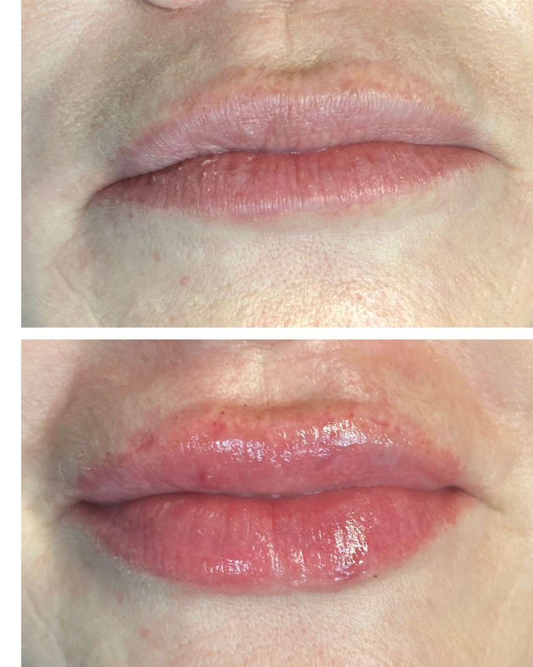 Aumento de labios