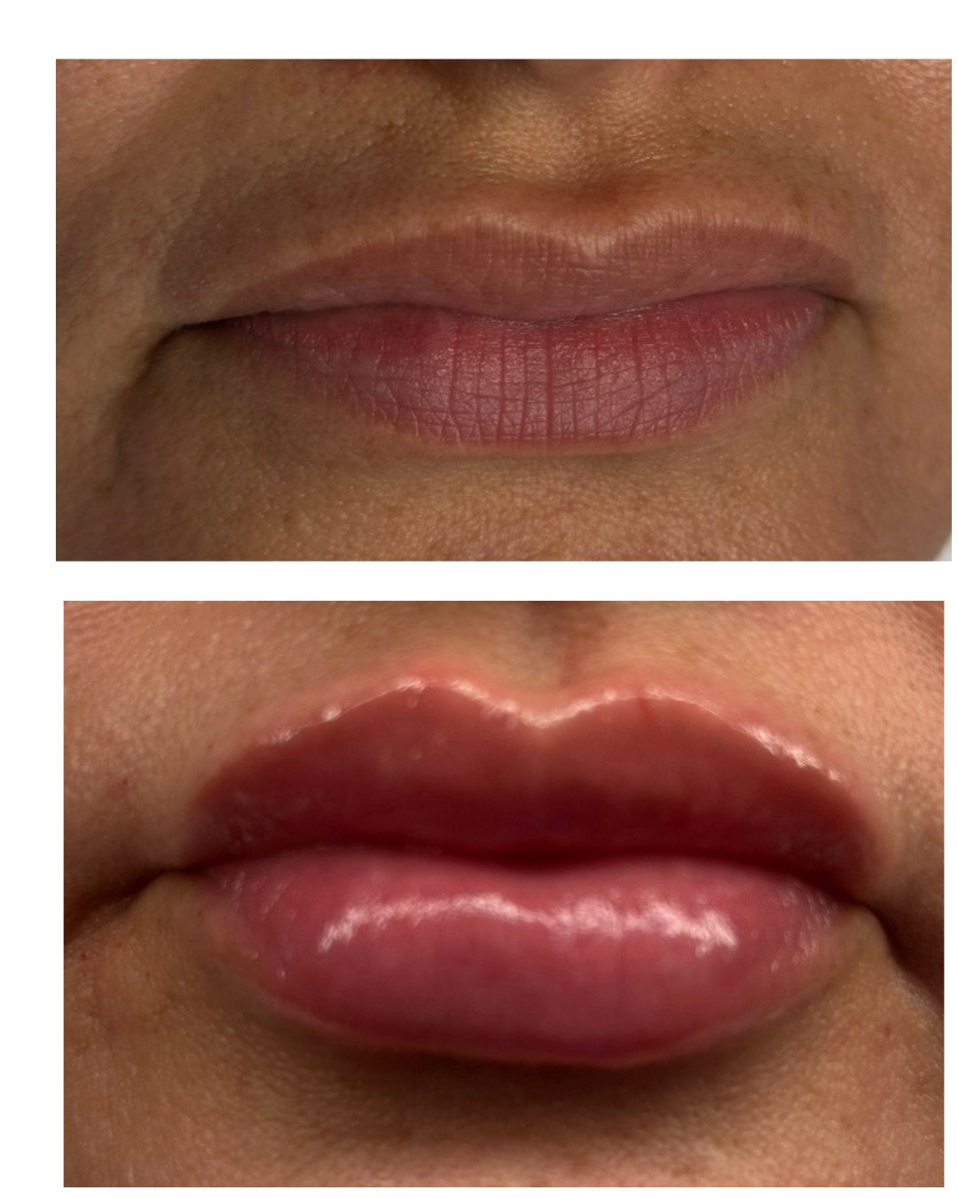 Aumento de labios
