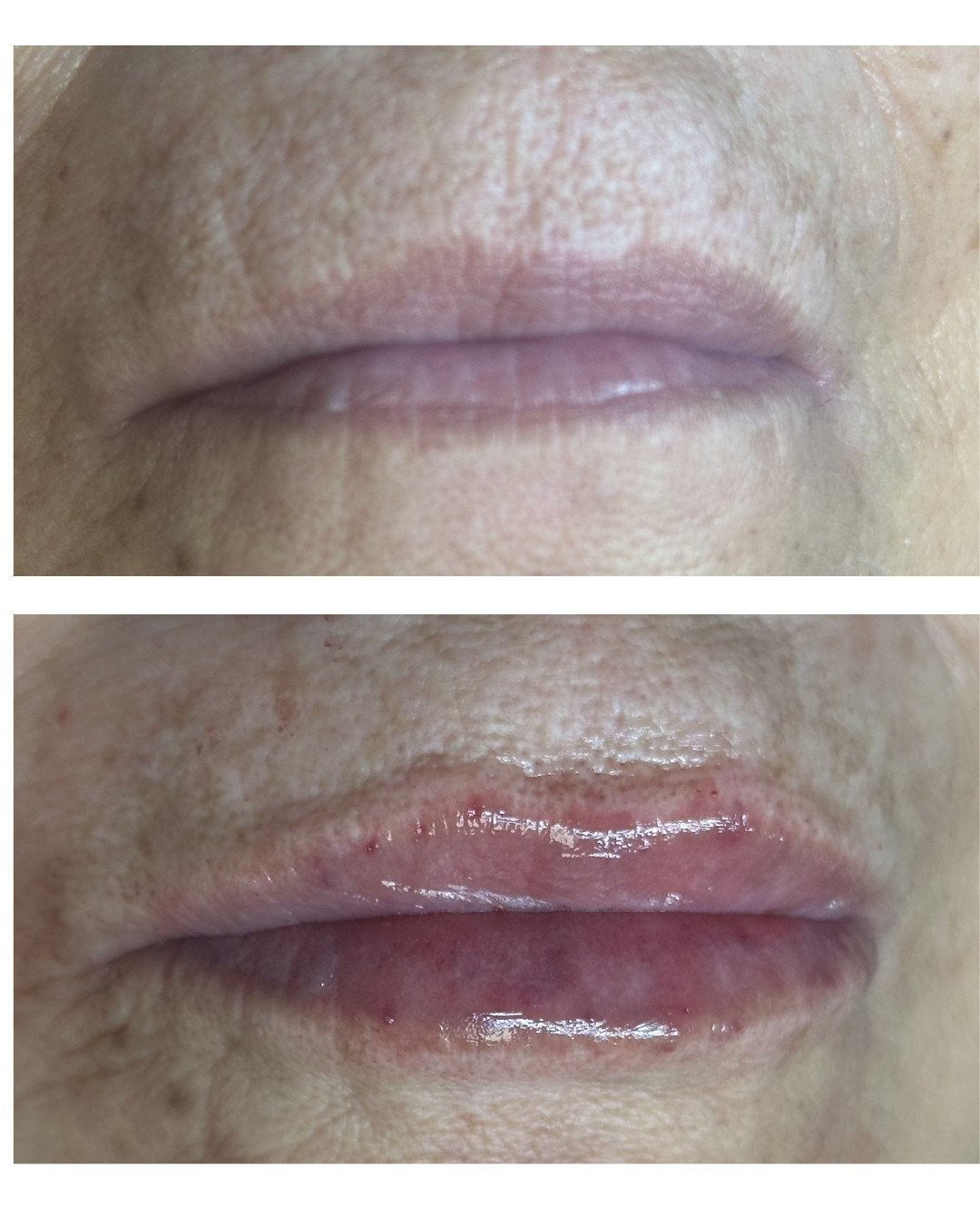 Aumento de labios