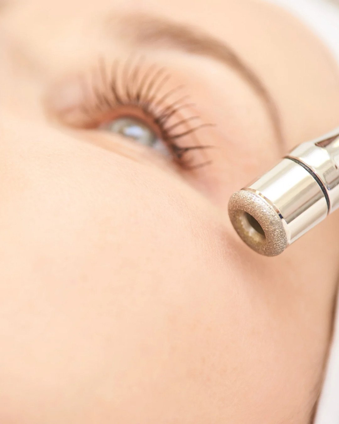 Microdermoabrasión