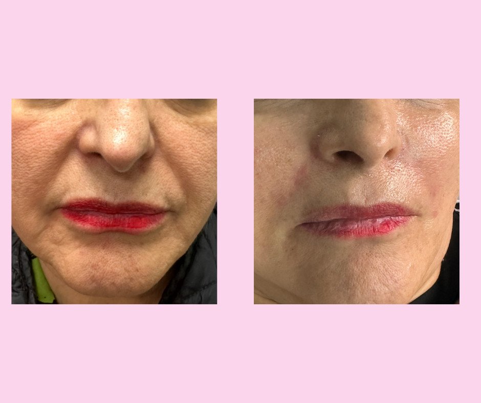 Relleno facial