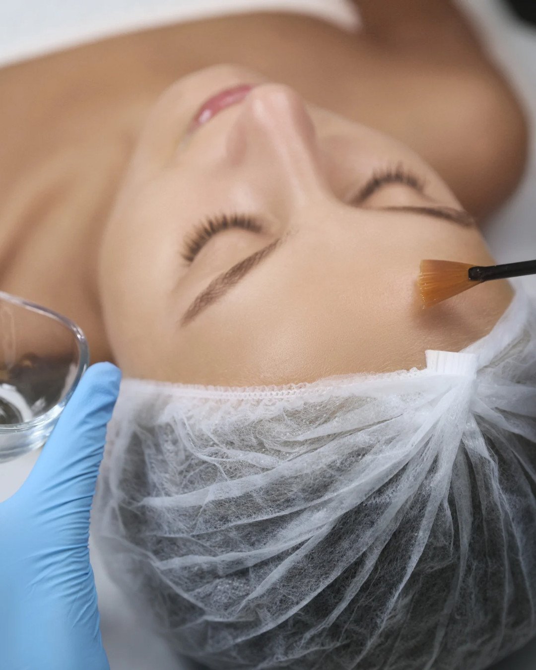 Peeling Químico