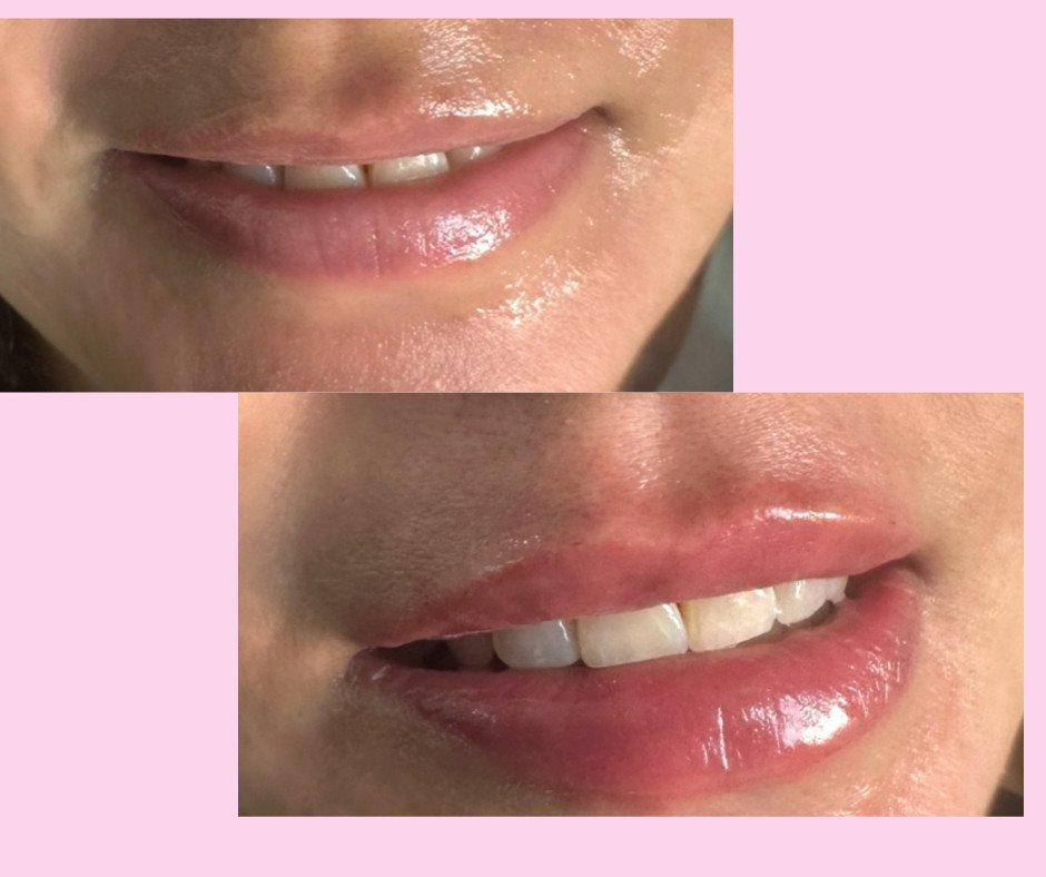 Aumento de labios