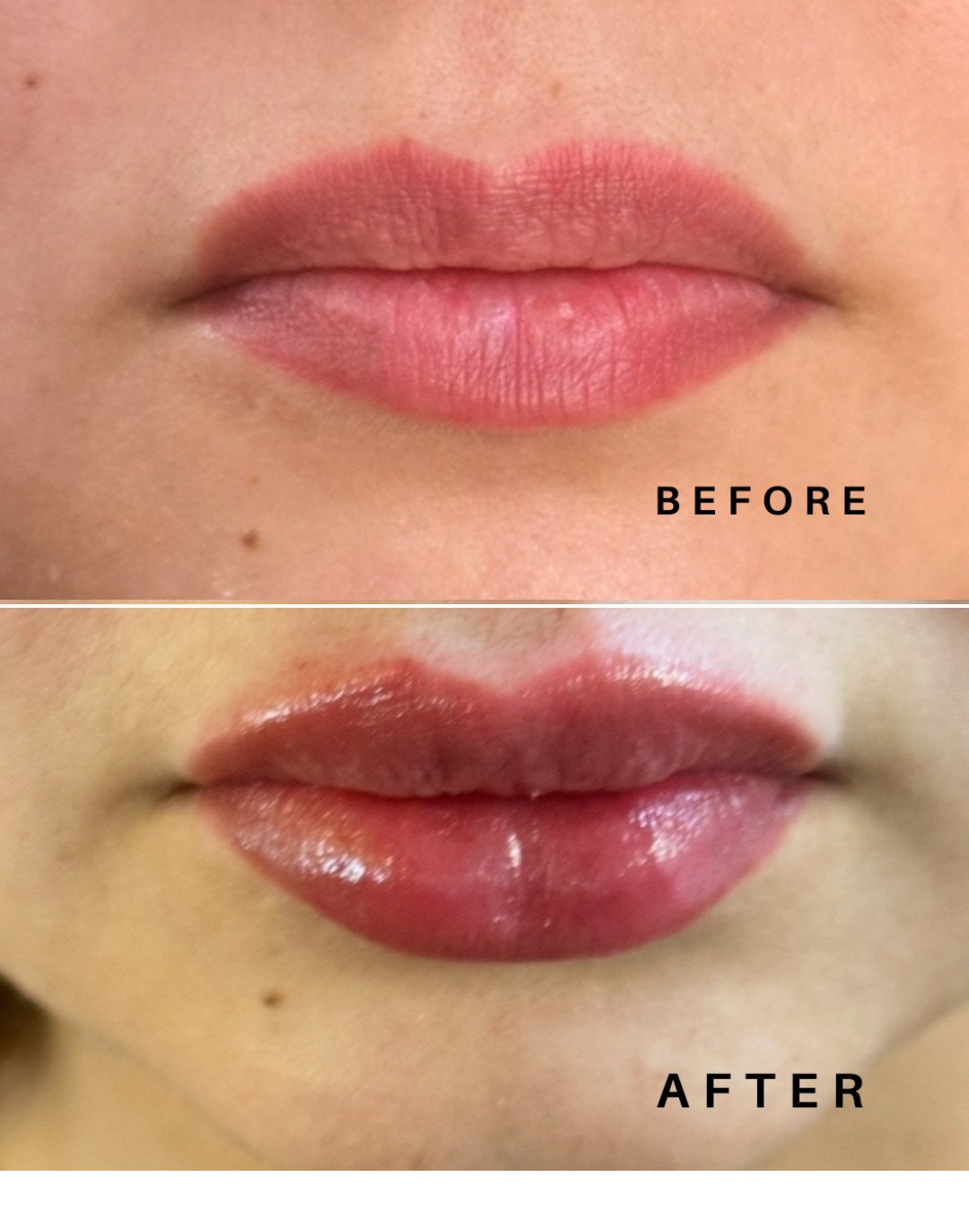 Aumento de labios