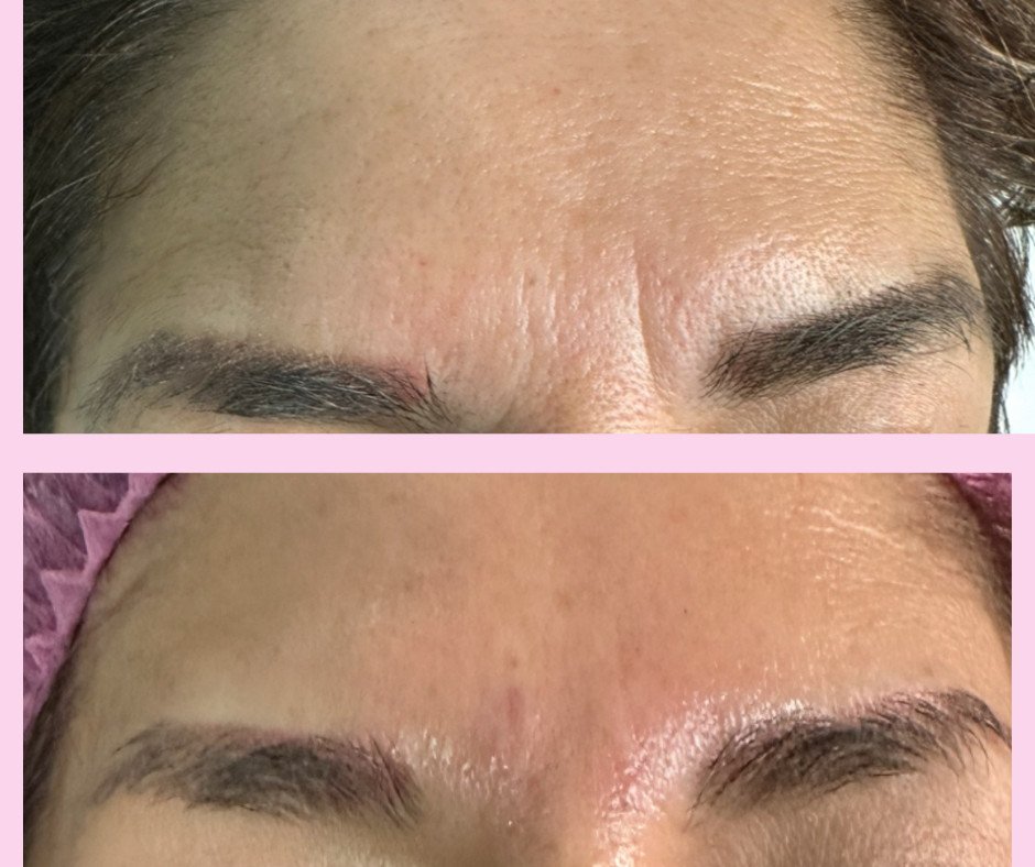 Relleno facial