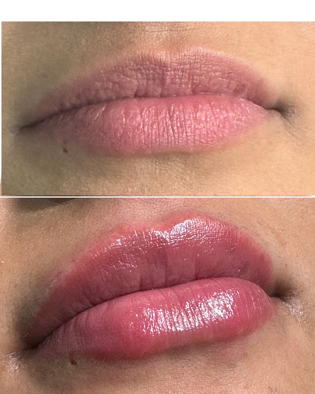 Aumento de labios