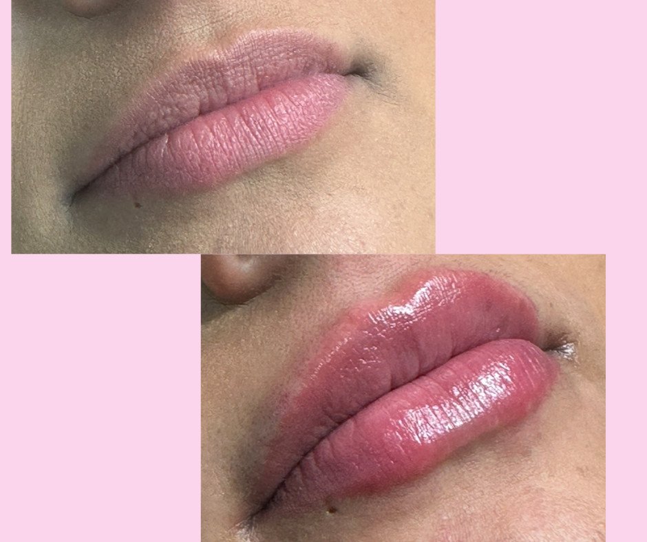 Aumento de labios