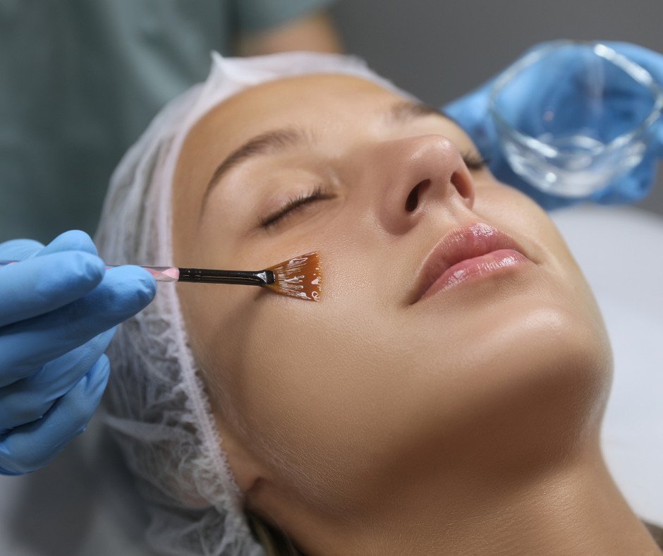 Peeling Químico
