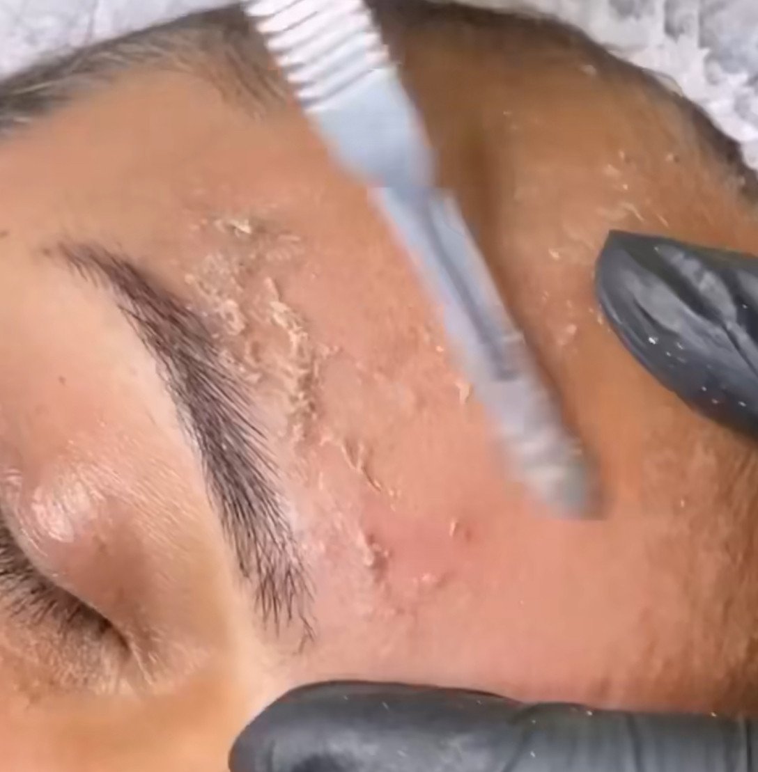 Dermaplaning